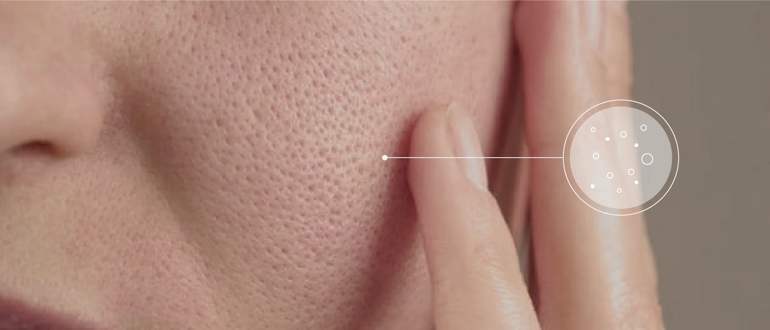 Pores & Blackheads