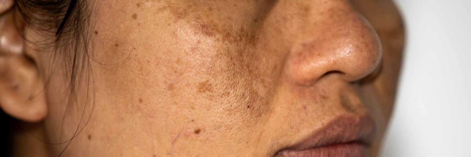 Dark Spots & Hyperpigmentation